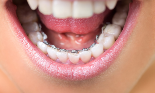 Smile designing