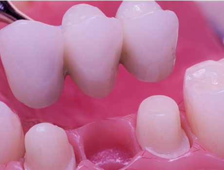 Replacement of missing teeth