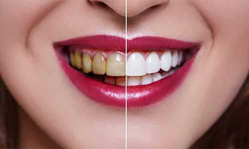 Full Mouth Rehabilation