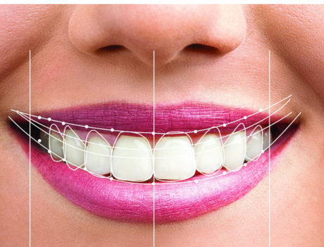 Smile designing